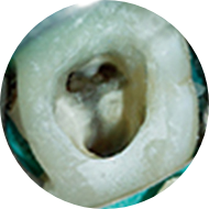 マイクロスコープで見た根管内の様子