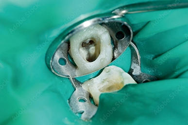 マイクロスコープで見た根管内の様子