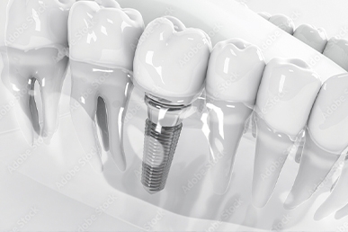 インプラント治療のイメージ画像