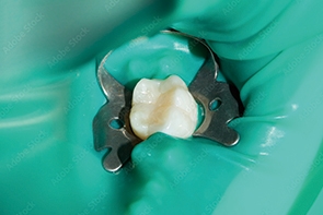 ラバーダムの画像