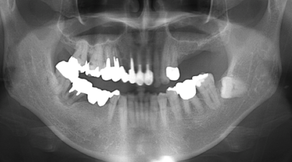 治療前レントゲン画像｜【症例】歯根破折により壊れてしまったブリッジをインプラントにより再建｜大船の歯医者「大船みらい歯科」