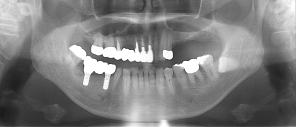 治療後レントゲン画像｜【症例】歯根破折により壊れてしまったブリッジをインプラントにより再建｜大船の歯医者「大船みらい歯科」
