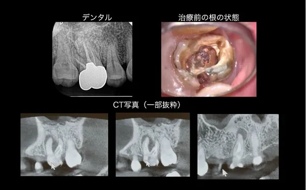 治療前画像|【症例】他院で抜歯を勧められた奥歯を、精密根管治療で保存的に治療|大船の歯医者「大船みらい歯科」