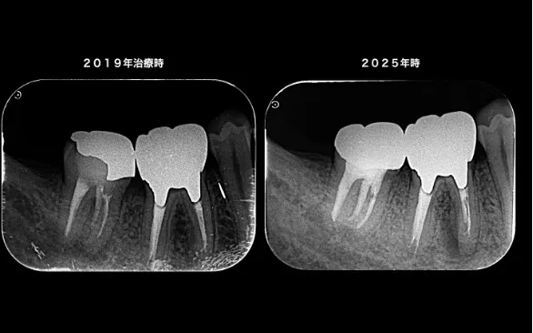治療前レントゲン画像｜【症例】再根管治療後に歯根破折を認め、インプラント治療で改善｜大船の歯医者「大船みらい歯科」