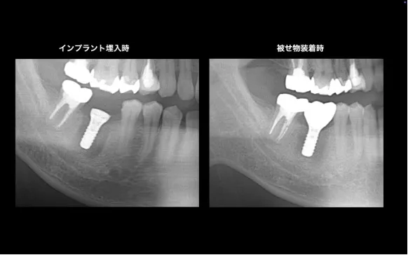 インプラント埋入、被せ物装着レントゲン画像｜【症例】再根管治療後に歯根破折を認め、インプラント治療で改善｜大船の歯医者「大船みらい歯科」